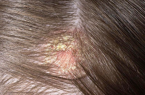 La raíz de la bardana el tratamiento de la psoriasis